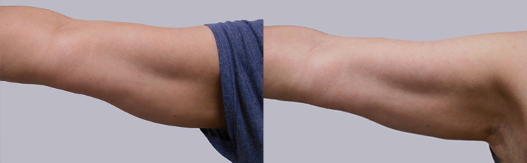 Vorher-Nachher Kryolipolyse Arm